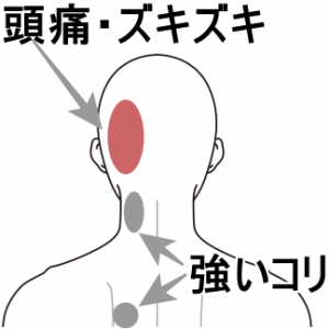 左 後ろ 頭 が 痛い