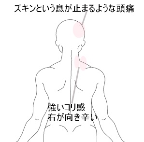 頭痛の治療例 神奈川県厚木市の鍼灸 はりきゅう 専門 県央治療院 小田急線本厚木駅徒歩３分